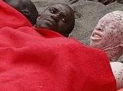 Gobierno español concede asilo como refugiado emigrante negro albino peligro muerte