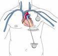 Ablacion Cardiovascular Cateter