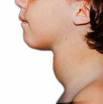 Masa origen tiroideo