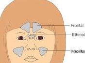 mayoría rinosinusitis víricas necesitan tratamiento antibiótico