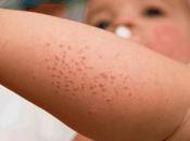 dermatitis contacto bebé