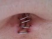 Laparoscopia
