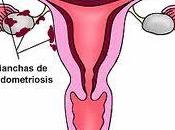 Relación entre endometriosis cáncer ovario