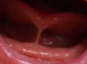 Frenillo sublingual corto anquiloglosia