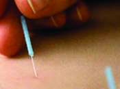 Acufenos Acupuntura Como Tratamiento