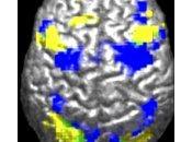 Neuronas Espejo Afectan Autismo