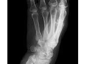 Osteoporosis