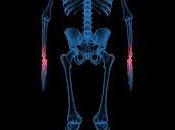 Tipos Artritis