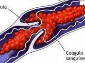 nuevo procedimiento podría ayudar pacientes trombosis venosa profunda