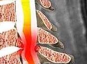 Cambios cerebrales compresión medular