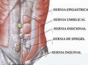 Hernia Spiegel.