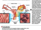 endometriosis: síntomas tratamiento