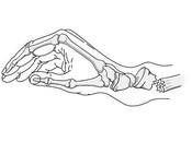 rehabilitación tras fractura Colles