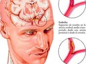 accidentes cerebrovasculares interrumpen función muscular