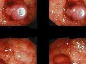 Aprueban nuevo fármaco para tratar cáncer colon