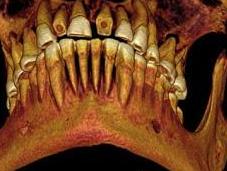 Encuentran momia egipcia 2.100 años antigüedad empastes dientes