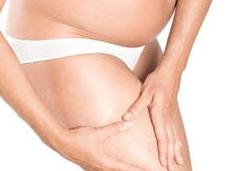 Varices embarazo