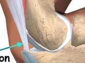 diferentes tipos bursitis afectan nuestra salud