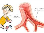 Alivio natural bronquitis