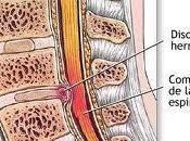 ¿Sirve Quiropráctica para curar hernia disco?