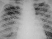 tipos frecuentes tuberculosis afectan nuestra salud