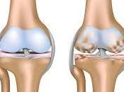 Pilates para dolor articular rodilla Osteoartritis