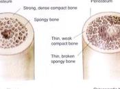 Osteoporosis, cómo prevenirla