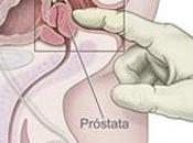 Forma diagnosticar cáncer próstata