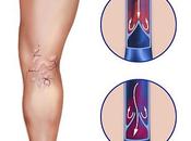 hombres toman serio varices