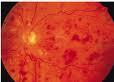 Allergan recibe opinión positiva CHMP Europa para tratamiento edema macular provocado oclusión vena retiniana
