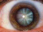 catarata, enfermedad causa posible aparición