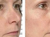 Radiofrecuencia Centro Estética Leo.