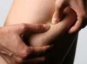 ¿Que ocasiona aparición celulitis?