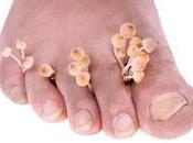 Láser para hongos uñas