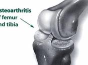 Consuma Pescado Para Prevenir Osteoartritis