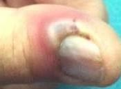 Orzuelos, forúnculos, uñeros sabañones. Cuando infecciones locales sociales