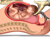 Anestesia general cesárea