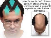 Hierbas para crecimiento cabello Remedios herbarios pérdida pelo