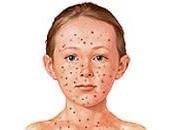 Vuelve varicela incluso algunos vacunados