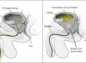 Vigilar hiperplasia próstata