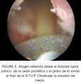 Vaporizacion Prostatica Plasma