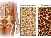 Aliada Osteoporosis