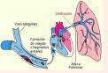 cada cuatro embolias pulmonares produce durante convalecencia
