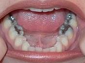 ☻¿cual problema amalgama dental?