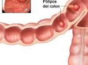 pólipos colon, causas tratamiento