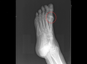 caso hallux rigidus (artrosis primer dedo pie)