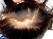 Excelentes resultados microimplante capilar alopecia femenina
