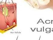 Sebium Global Bioderma, solución acné