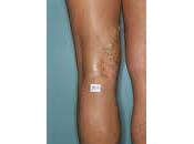 ¿Qué cómo originan varices?