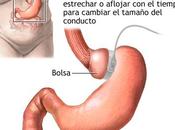 Banda gástrica, gastroplastia gastrectomía